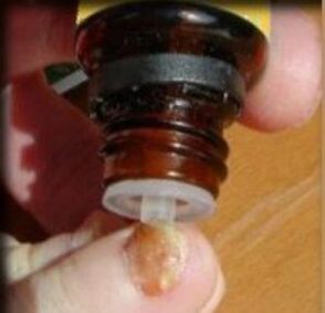 Pilienu uzklāšana uz sēnītes skarta kājas nagu